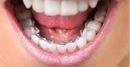 Alt Diş Teli Diş Teli Taktırmanın Yararları