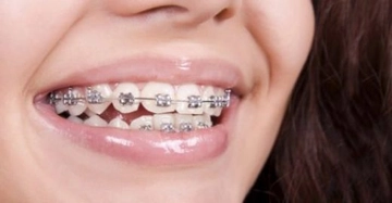 Diş Teli Acıtır mı?