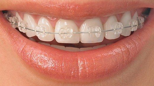 Alt Çene Diş Teli Etkileri