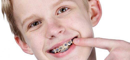 Çocuklarda Diş Teli Etkileri