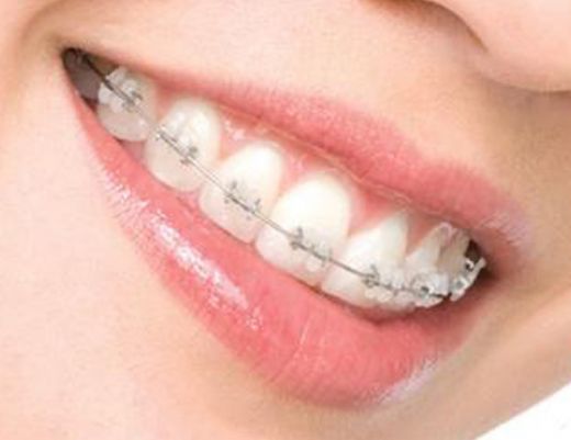 Diş Teli Aparatları Nelerdir?