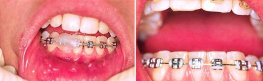 Diş Teli Mumu Dişe Nasıl Uygulanır?