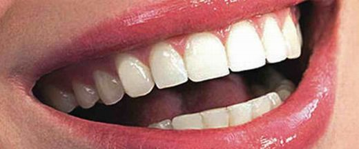 Diş Teli Sonrası Bozulma