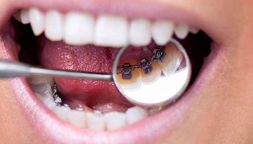 Lingual Diş Teli Etkileri