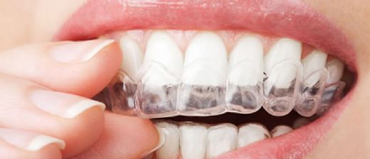 Saydam Diş Teli Avantajları